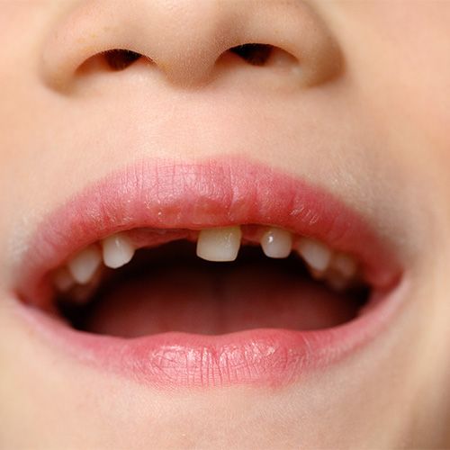 Niño con dientes por crecer